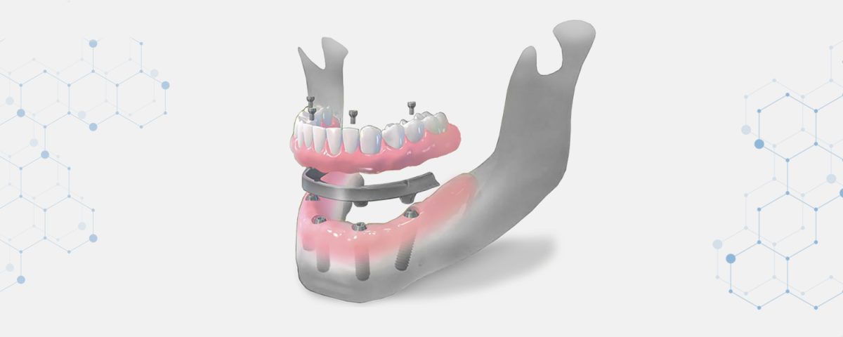 hatterkep-implantatum-all-on-4-modszer3